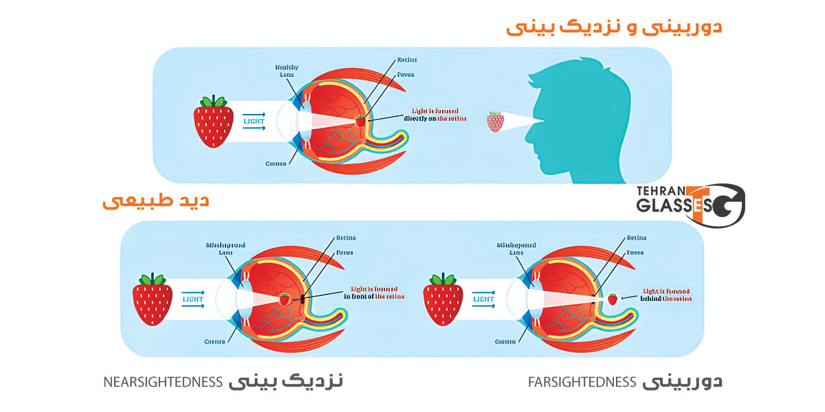 بررسی جامع دوربینی و نزدیکبینی: علل، علائم و روشهای درمان 7 عینک تهران فروشگاه عینک های اورجینال بررسی جامع دوربینی و نزدیکبینی