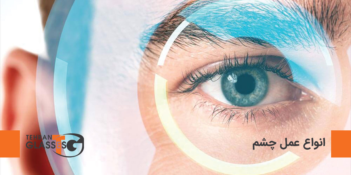 انواع عمل های جراحی چشم